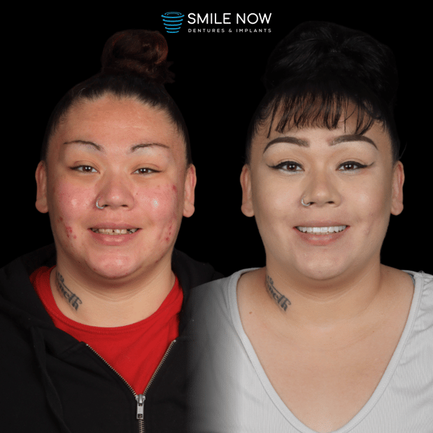 Images Smile Now Milwaukee Dentures and Implants
