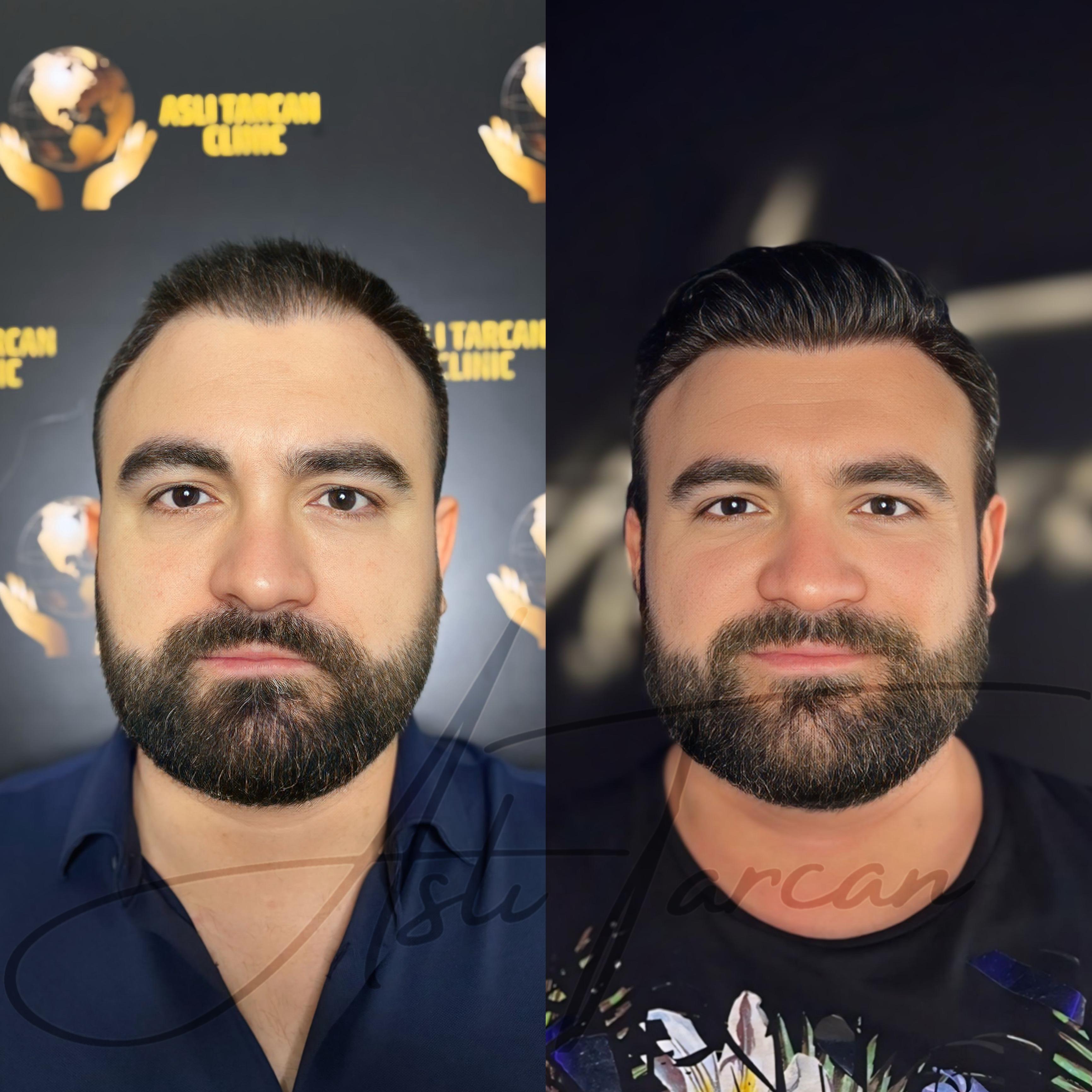 Bild 8 Asli Tarcan Clinic | Haartransplantationen in der Türkei Istanbul in Köln