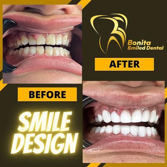 Bonita Smiled Dental - smile design