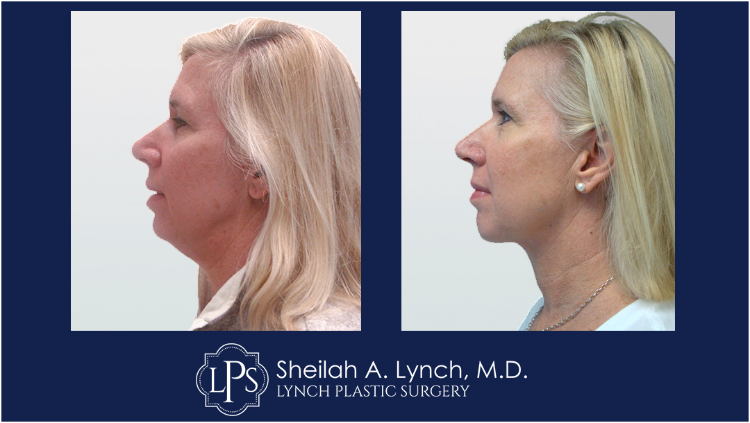 Neck Lift Before & After Patient Chevy Chase Maryland. Plastic Surgeon Near Me Sheilah A. Lynch, MD
