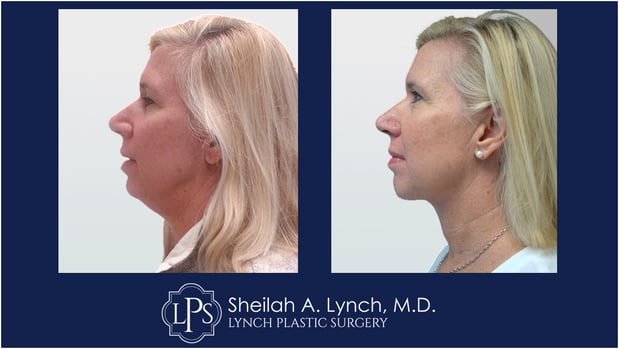 Images Sheilah A. Lynch, MD - Lynch Plastic Surgery