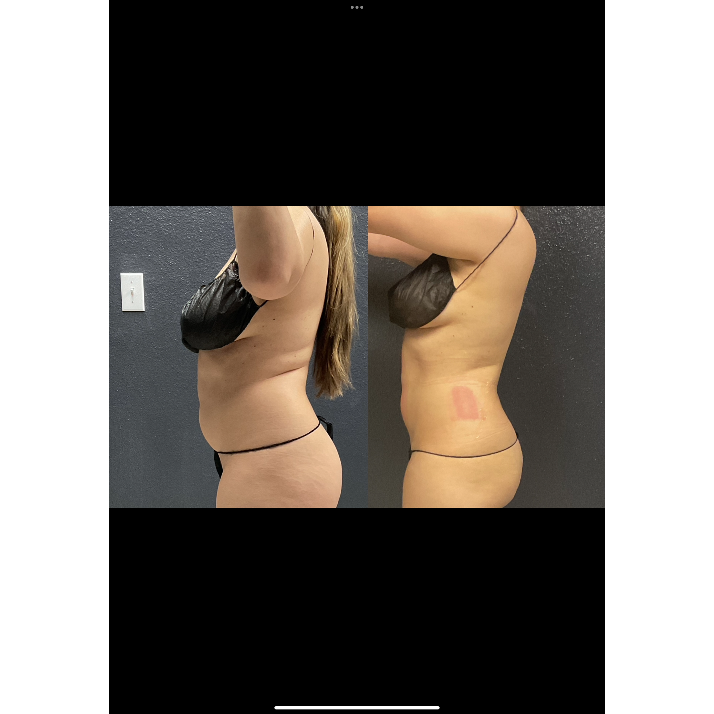 Before-and-after results showing a slimmer waistline and reduced abdominal fullness following a customized nonsurgical body-contouring treatment at Grace MedSpa in Austin, Texas.