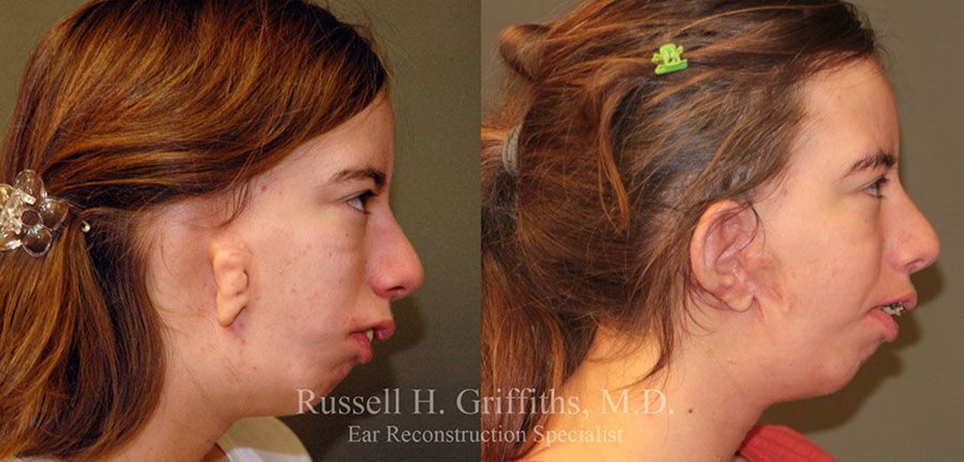 Results of Russell H. Griffiths, MD | Boise, ID