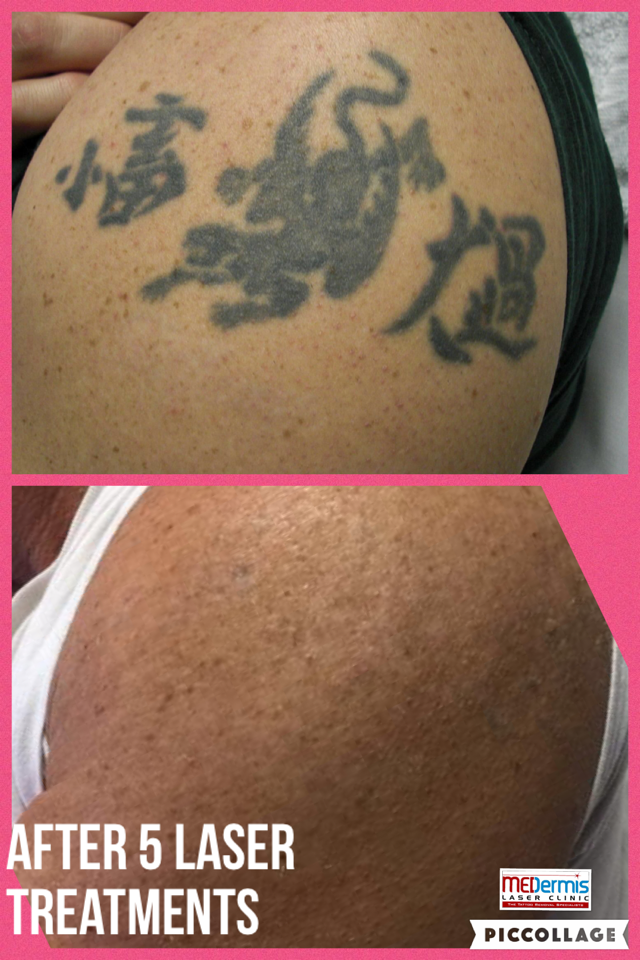 28 austin tattoo removal my friends austinpicosure com a 28 austin tattoo removal my friends austinpicosure com a