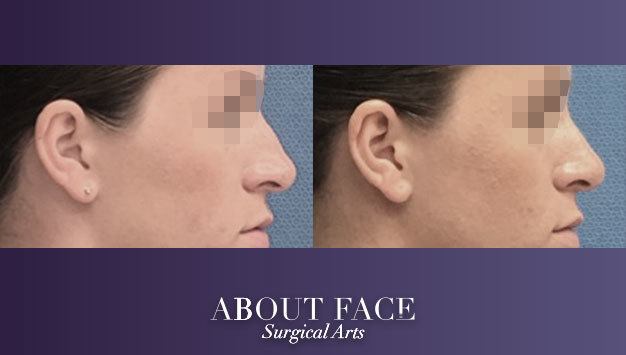 About Face Surgical Arts: Khurram A. Khan BDS, DMD Cincinnati (513)232-8989