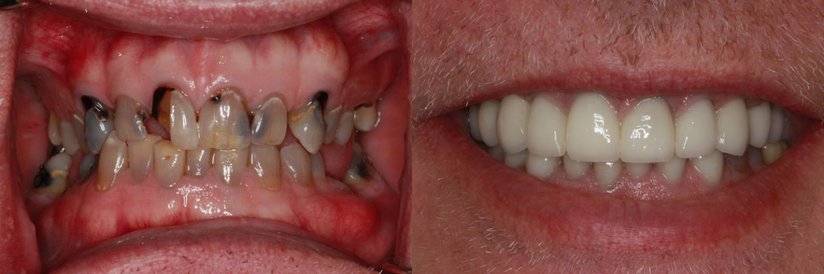 Before & After from Southern Dental Implant Center | Cordova, TN