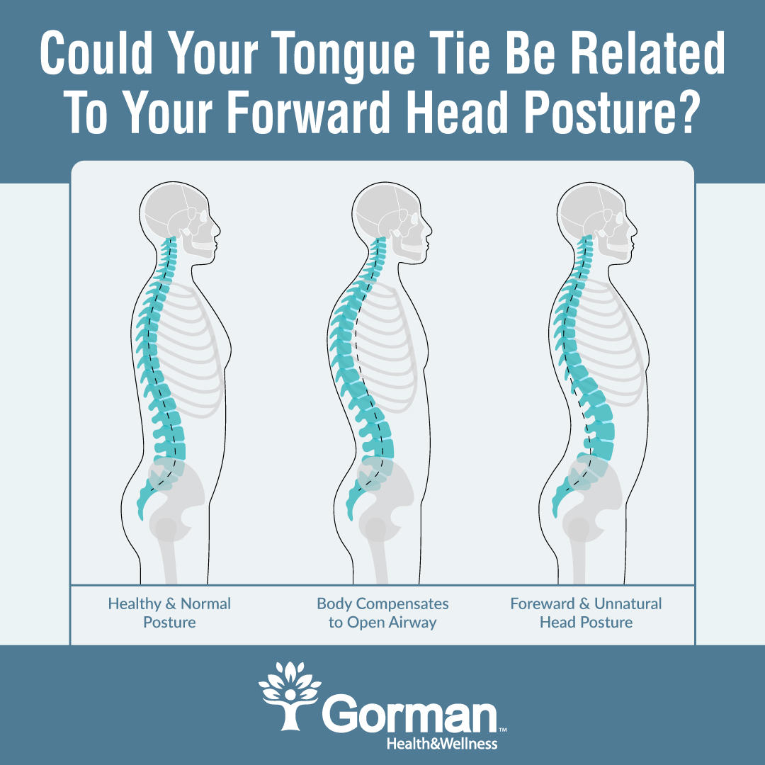 Tongue-tie is linked to several health problems; some of which may surprise you. Poor body and head posture are at the top of that list.
#MyofunctionalTherapy #TongueTie #SleepApnea