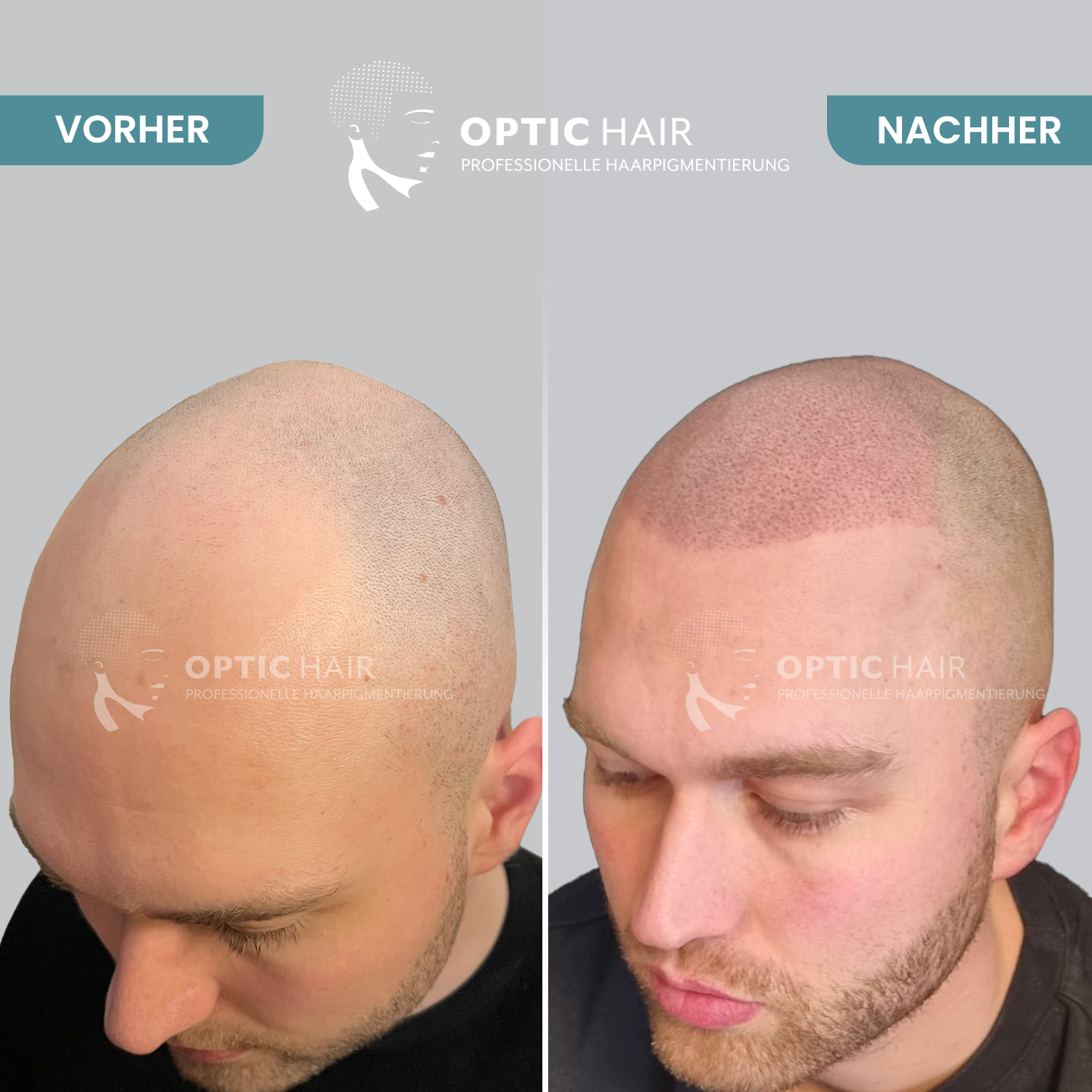 Kundenbild groß 27 Haarpigmentierung Köln | OpticHair