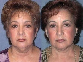 Before & After from Plastic Surgery Center of Tampa | Tampa, FL