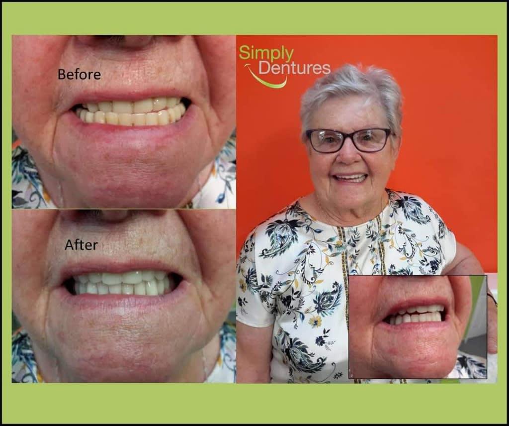 Images Simply Dentures