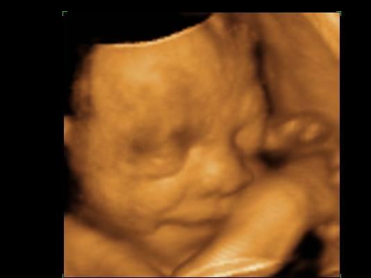 Belly 2 Birth 3D 4D Ultrasound Photo