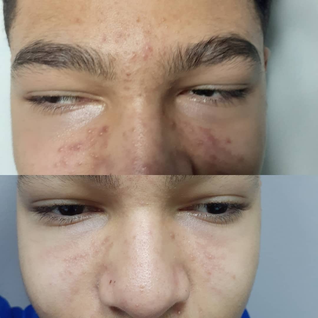 aesthetic laser treatment before and after