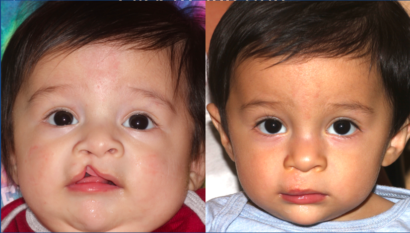 Before and After Unilateral Cleft Lip Repair