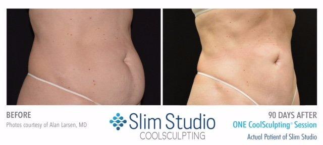 Slim Studio EMSCULPT & Coolsculpting Photo