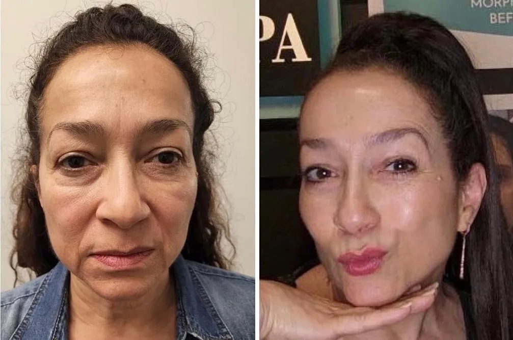 Facial Harmonization, Before & 6 Months After All Treatments, Botox, Morpheus8, Cheek Filler, Lip Filler