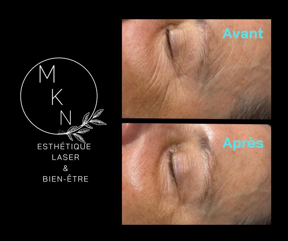 Images MKN Esthétique Laser & Bien-être