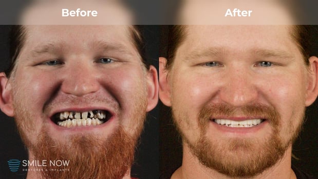 Images Smile Now Milwaukee Dentures and Implants