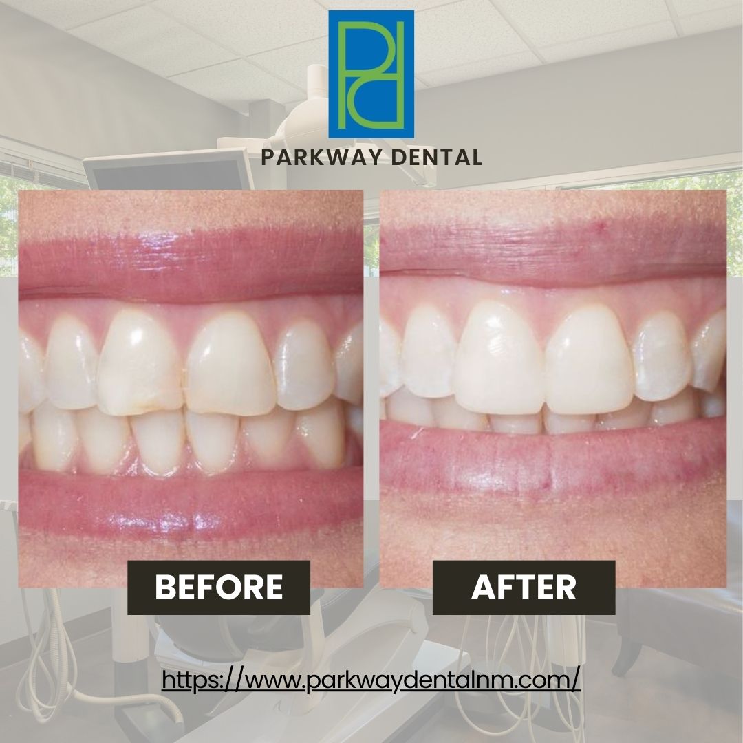 Before and after at Parkway Dental: Michael D Haight, DDS | Albuquerque, NM Parkway Dental: Michael D Haight, DDS Albuquerque (505)298-7479