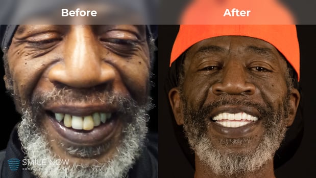 Images Smile Now Tacoma Dentures and Implants