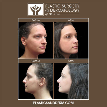 Rhinoplasty surgery requires an artistic, nuanced, and customized approach. Nose surgery can improve overall facial aesthetics, change the size and shape of the nose, correct a deviated septum, and reshape the nostrils. Dr. Levine is experienced in both open and closed rhinoplasty techniques as well as revision rhinoplasty. Even the most subtle changes to the nose can have a dramatic impact on both the look of the nose and facial aesthetics.
