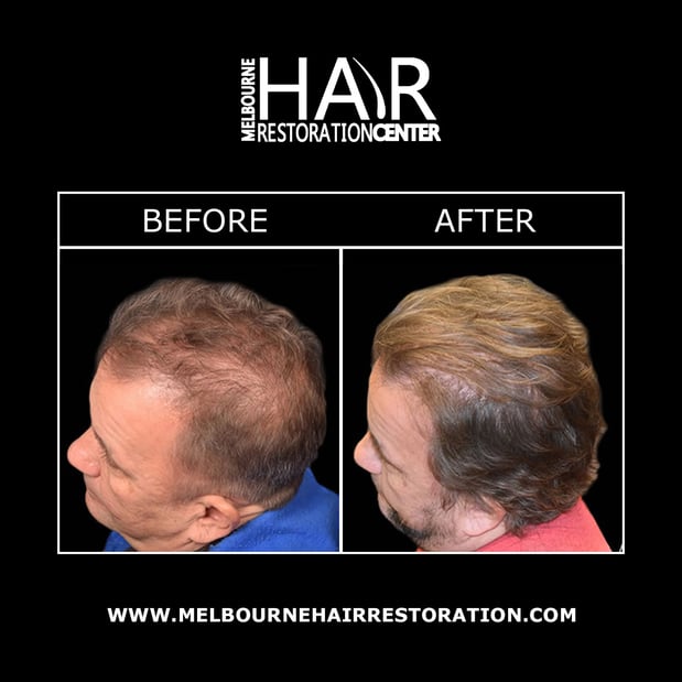 Images Melbourne Hair Restoration Center