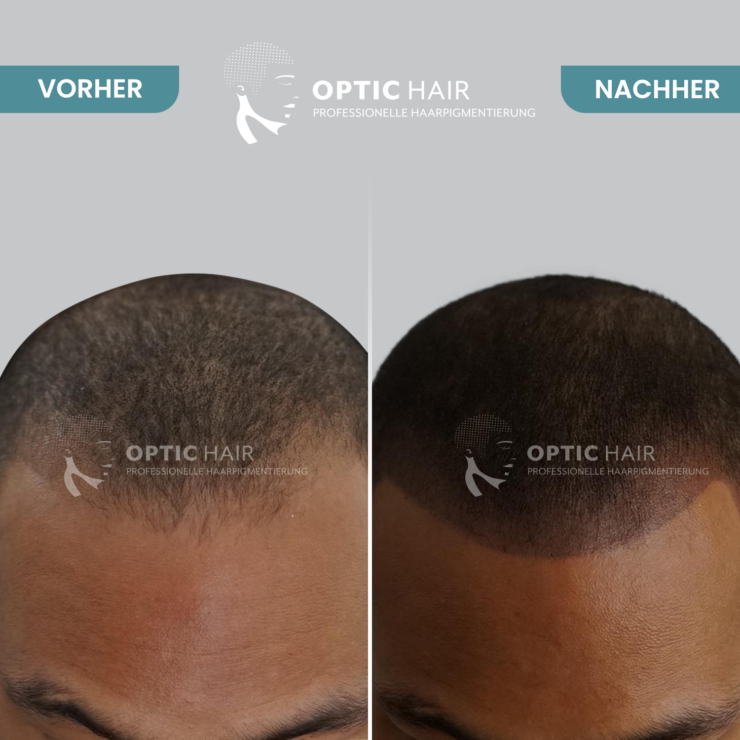 Kundenbild groß 16 Haarpigmentierung Köln | OpticHair
