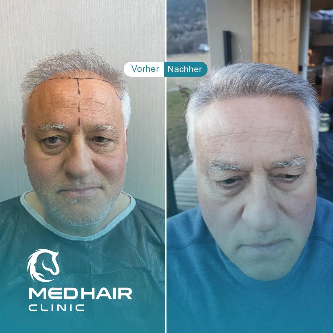 MedHair Clinic | Haartransplantationen in der Türkei Istanbul, Höninger Weg 176 in Rodenkirchen