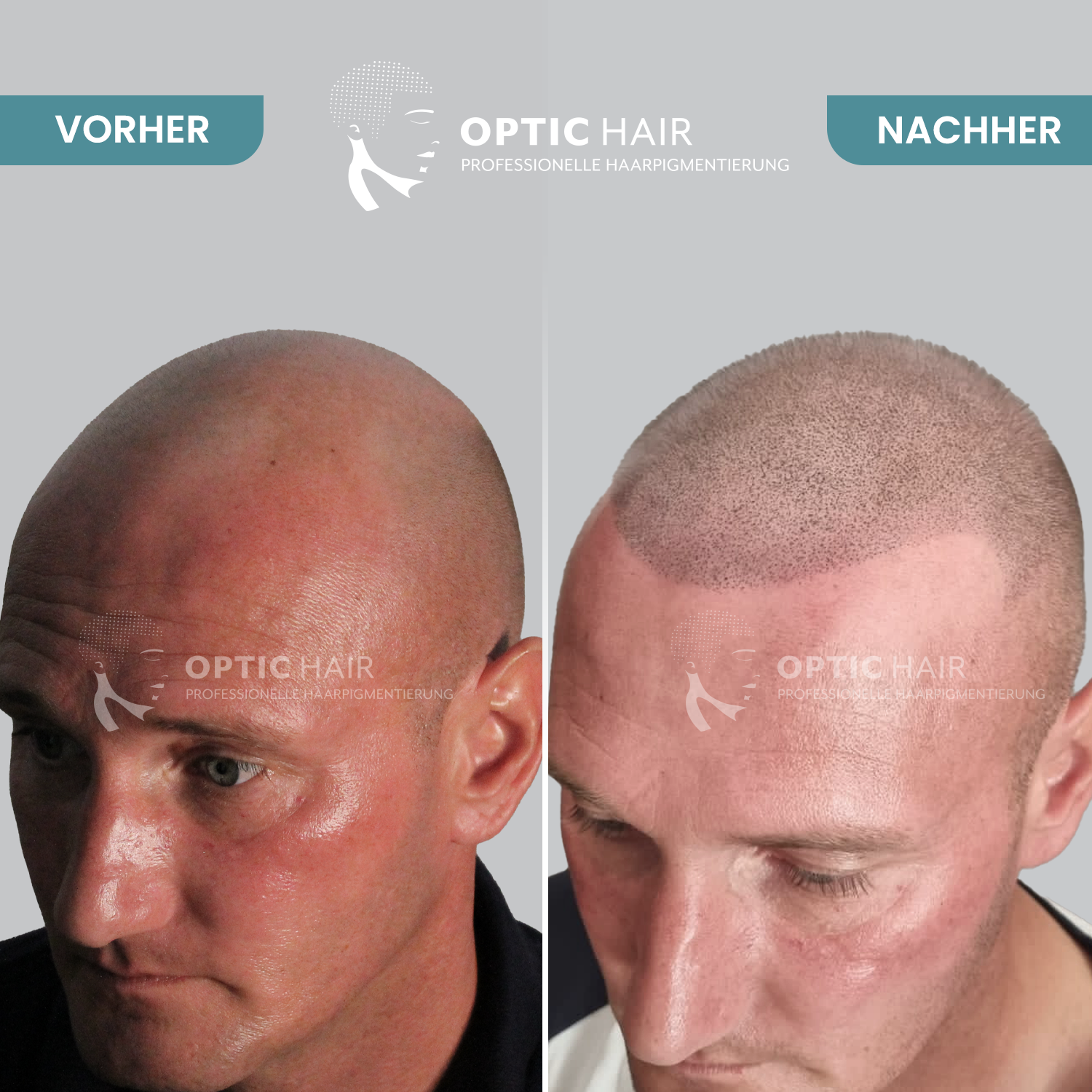 Bild 23 Haarpigmentierung Köln | OpticHair in Köln
