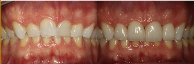 Before & After Results at Nordhus Dentistry | Wichita, KS