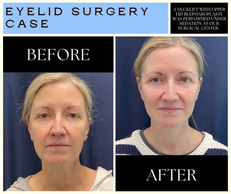 Columbia Aesthetic Plastic Surgery Eyelid Surgery
