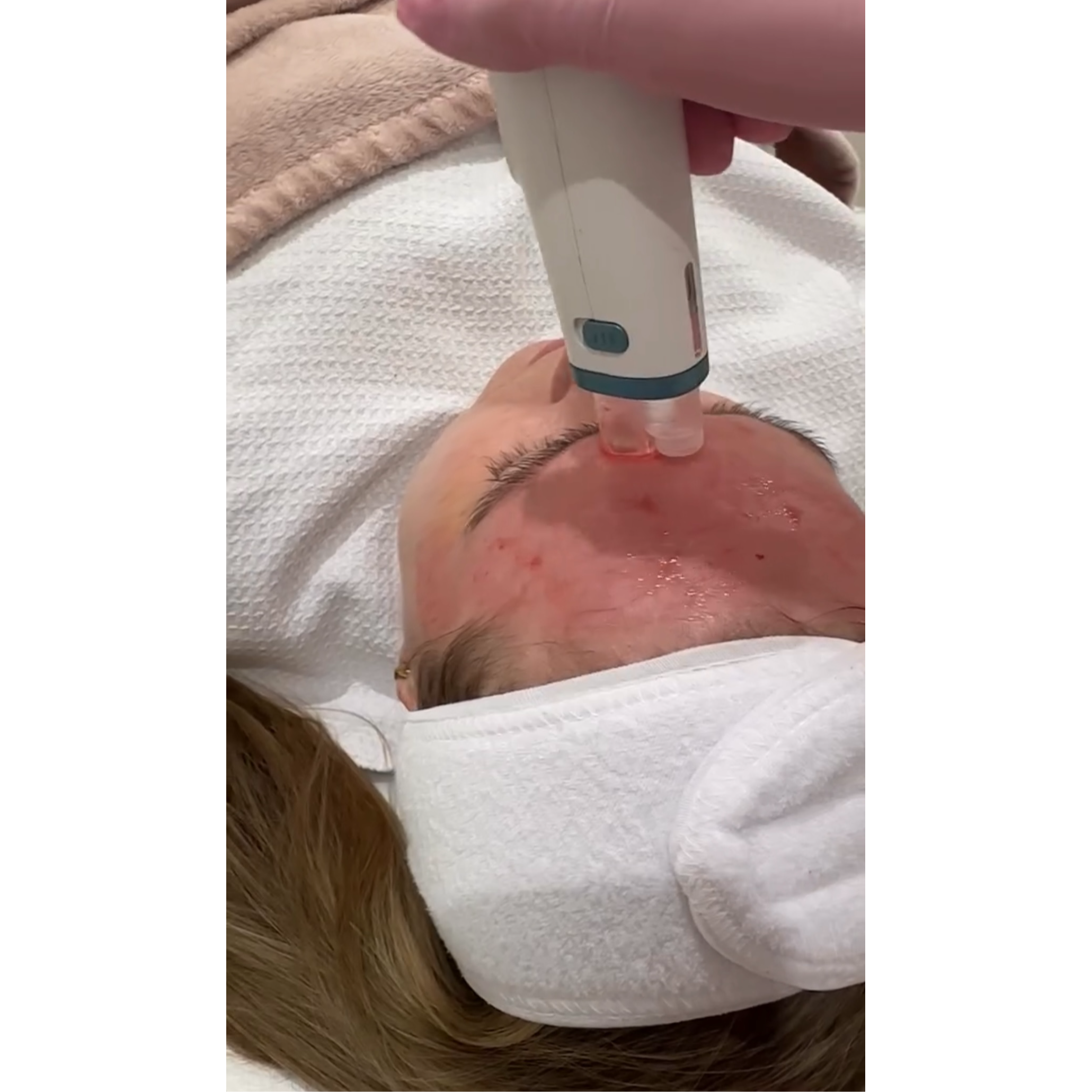 Microneedling treatment close-up at KWJ Skin Clinic, a professional aesthetic clinic in Horsham supporting skin rejuvenation, collagen stimulation, skin texture improvement and advanced skincare.