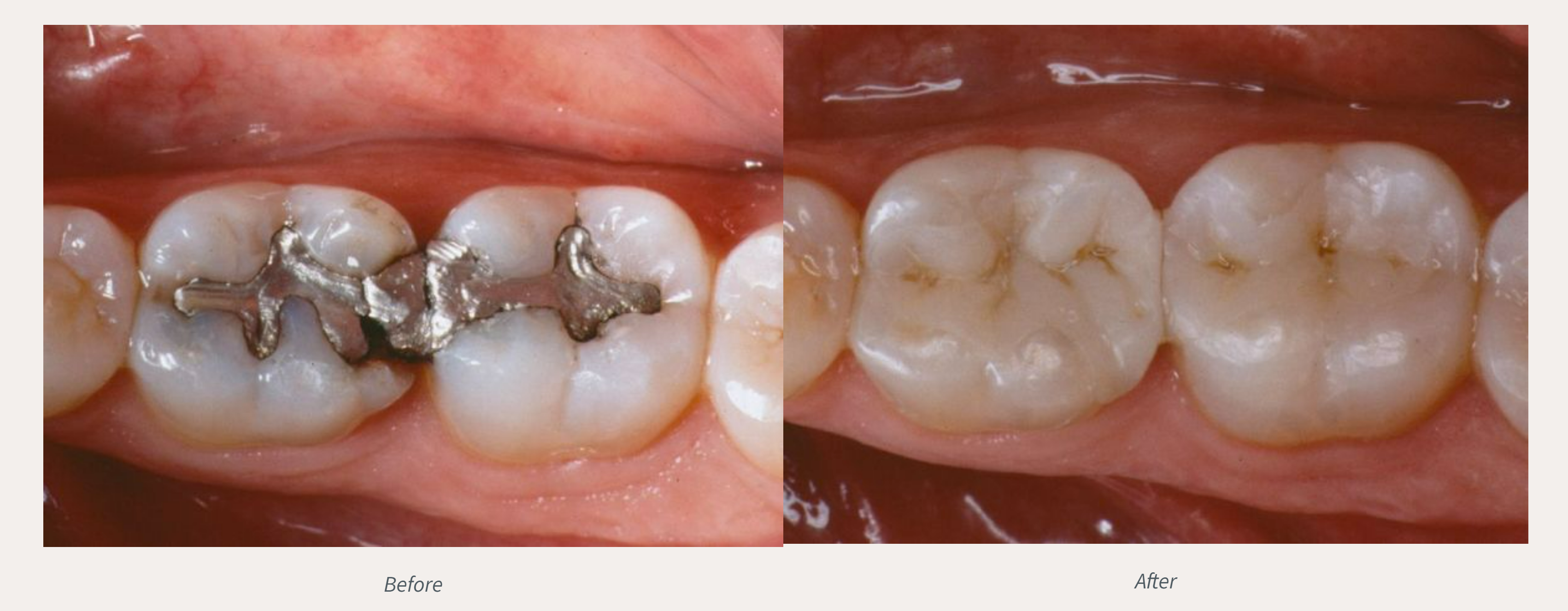 Tooth-colored Fillings Before & After from Advanced Dental Care | Valdosta, GA