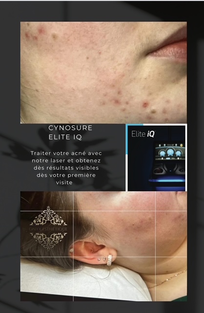Images Onyx Esthétique - Soins esthétiques, Soins de la peau, Laser Cynosure Gatineau
