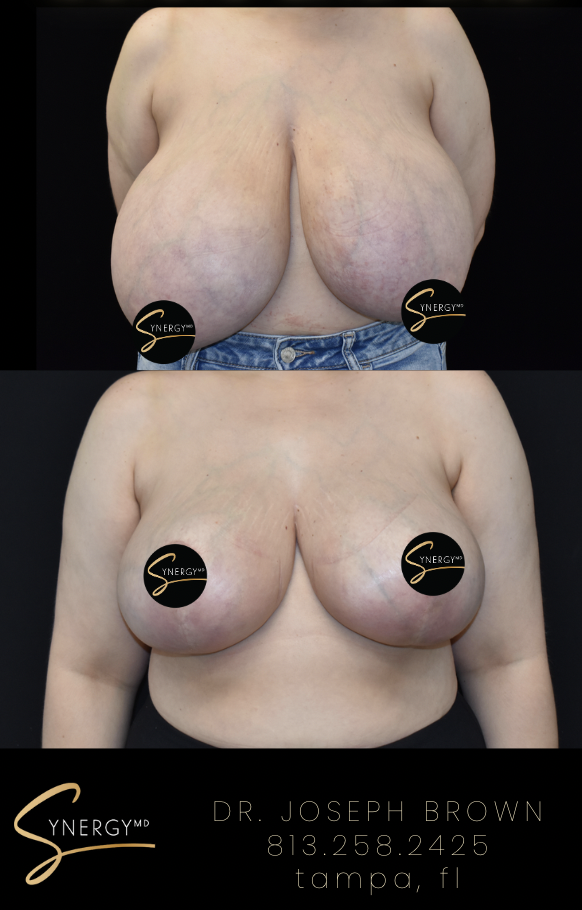 Before & After from SynergyMD Plastic Surgery | Tampa, FL