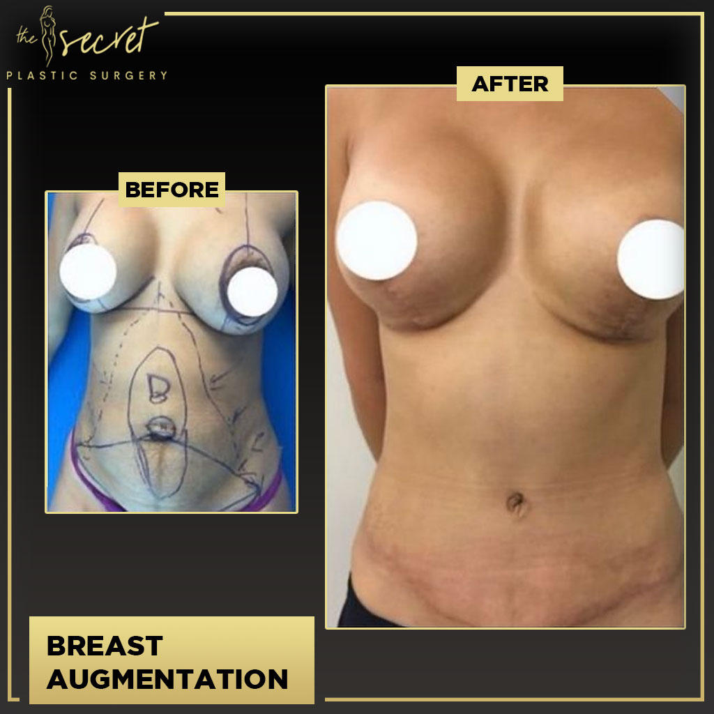 Breast Lift - The Secret Plastic Surgery