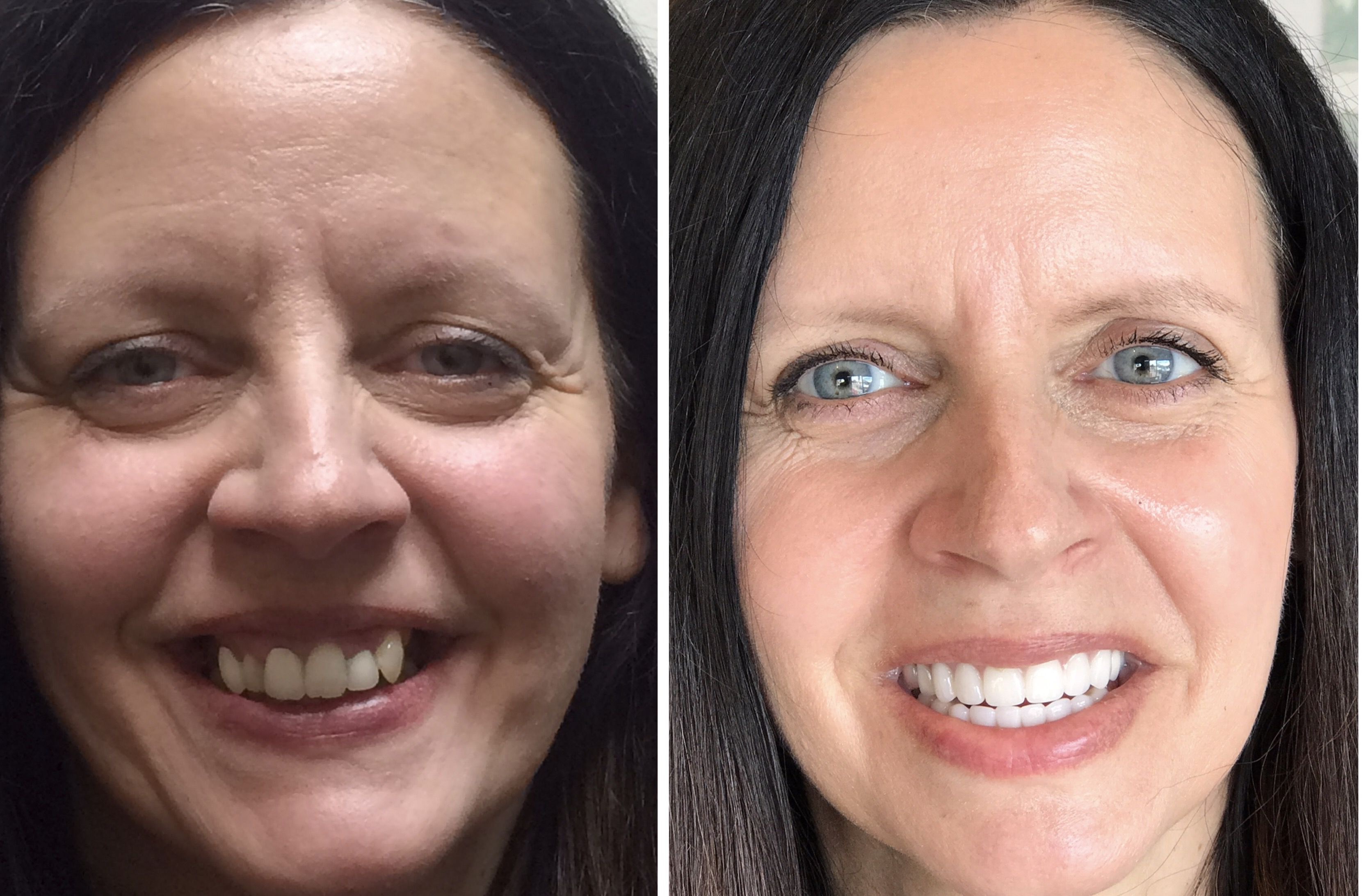 Before and After from Stubbs Dental | Murray, UT