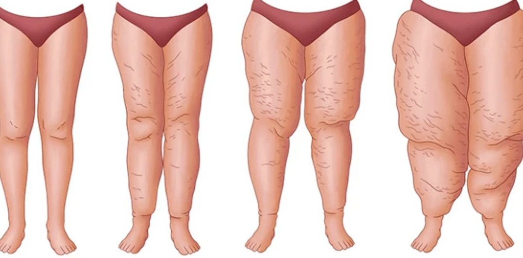 Bilder Medical Aesthetic Fettabsaugen Dr. Urs Benz