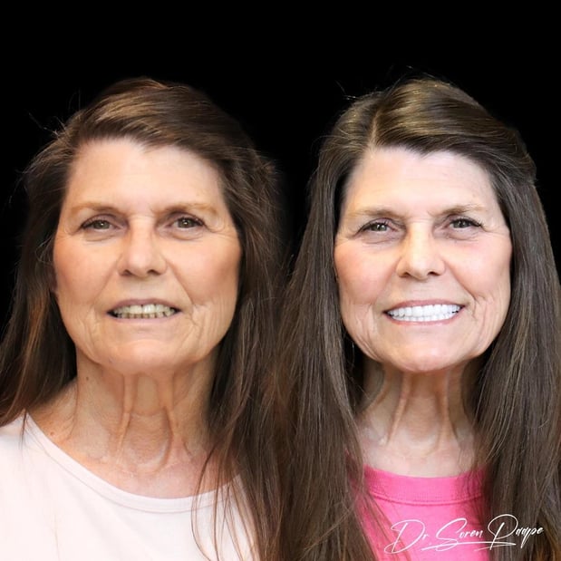Images Smile Now Denver Dentures and Implants