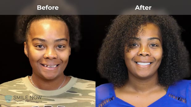 Images Smile Now Milwaukee Dentures and Implants