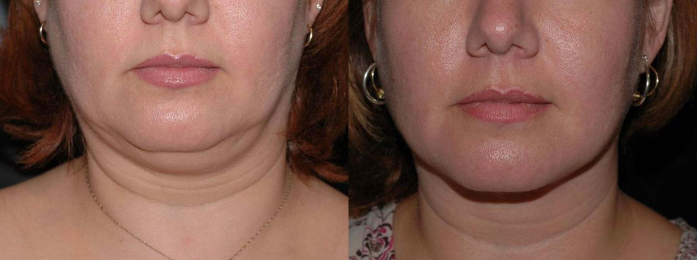 Before & After at Carmel Cosmetic and Plastic Surgeons | Carmel, IN