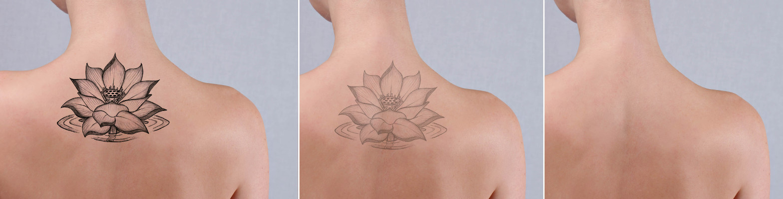 If you have tattoos you regret, turn to us for our coverup and removal services.