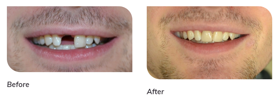 Before & After Results from Peak Family Dentistry | Albuquerque, NM