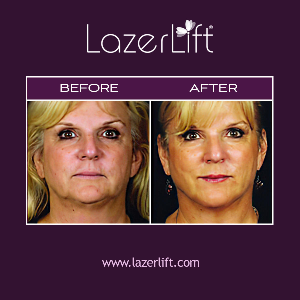 A neck lift in Tampa works to lift and tighten skin that has lost its elasticity due to the effects of gravity. LazerLift® is a non-invasive solution to treat lax neck skin and neck bands. Before LazerLift®, neck lift surgery was required to reverse the effects of aging. Now, patients can enjoy a youthful neck without the lengthy procedure or healing process.