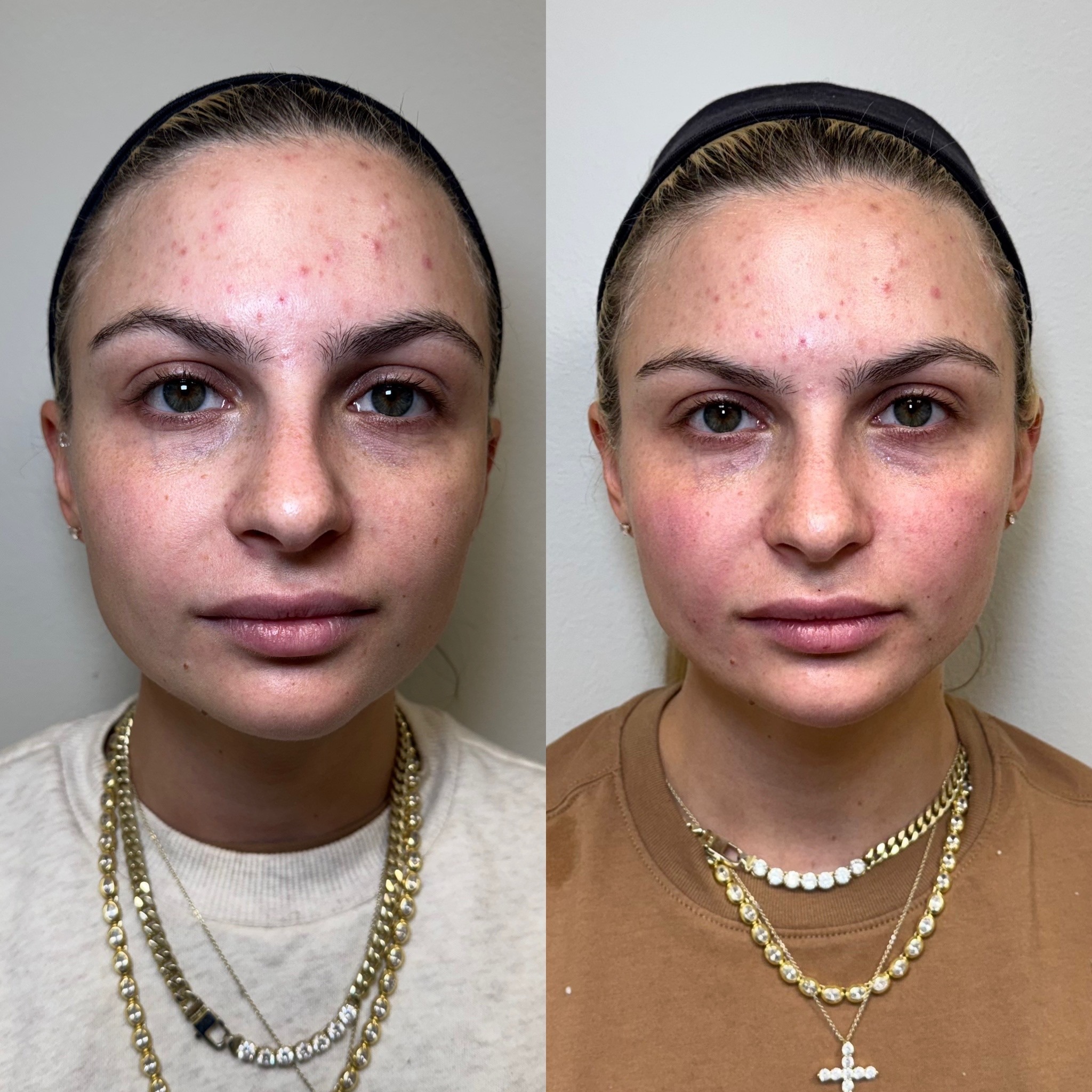 Natural-looking before and after results, Care Esthetics Delaware