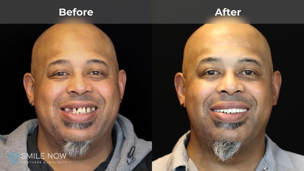 Images Smile Now Milwaukee Dentures and Implants