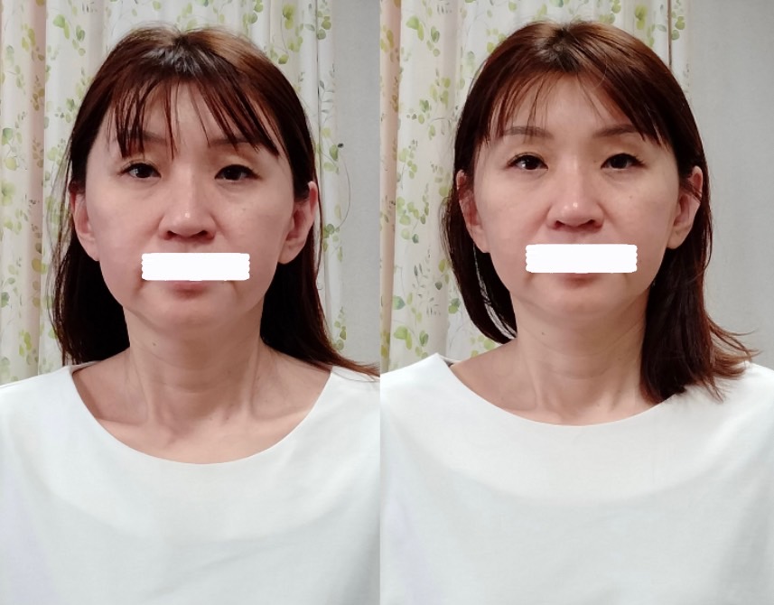 Images 目元・口元のたるみ&眉間シワ改善専門サロン