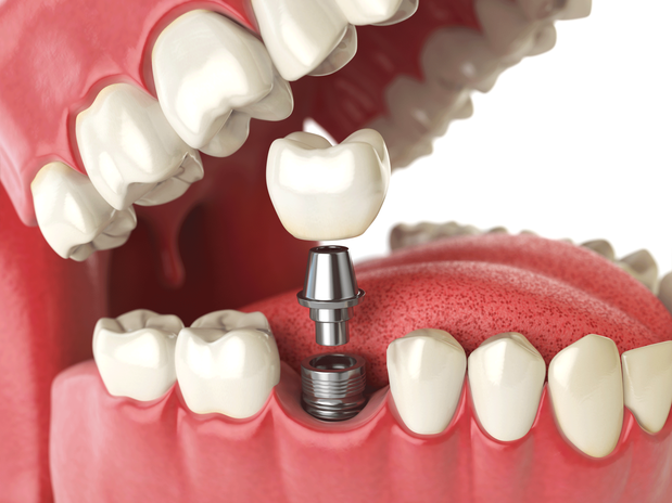 Images BDG Advanced Dental Implant Center