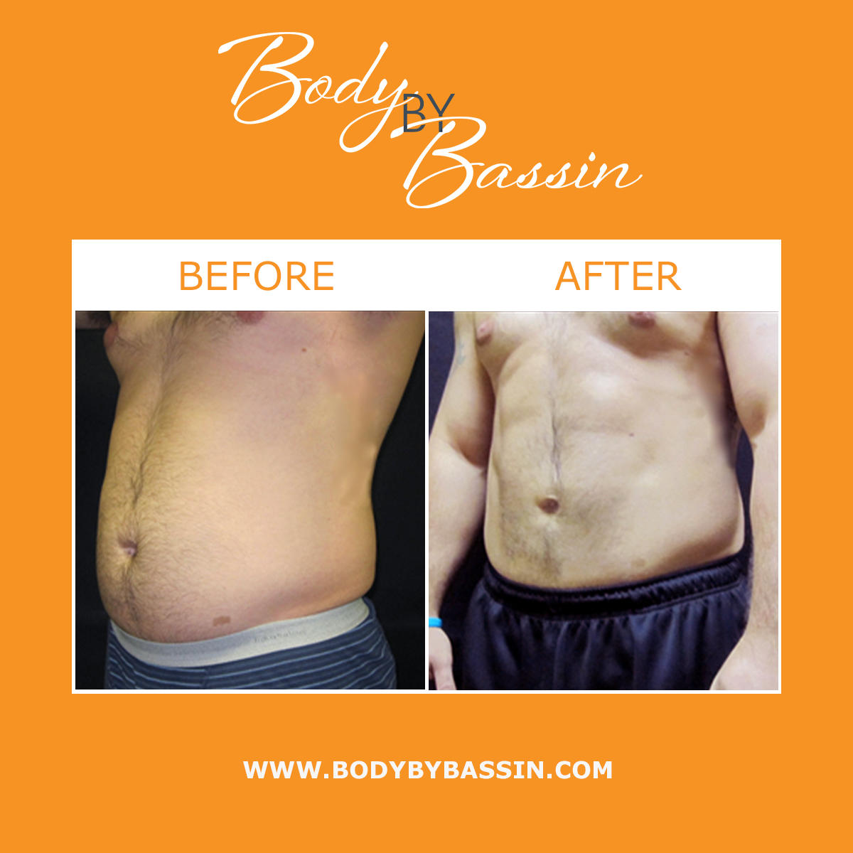 Male liposuction in Orlando can remove excess fat from the abdomen for a more sculpted physique. Lipo for men can provide long-lasting, natural-looking definition to the abdomen by targeting stubborn fat deposits that are often resistant to diet and exercise.