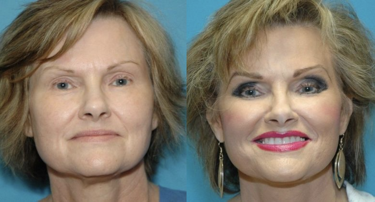 Before and after at Lowe Plastic Surgery | Oklahoma City, OK