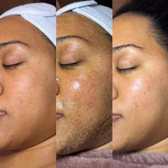 Treatment progression photos showing post-treatment skin texture changes.